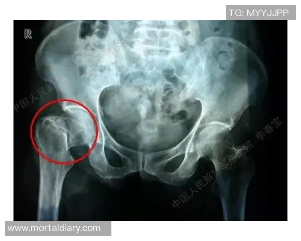 萨格斯髋部挫伤，复出视治疗反应